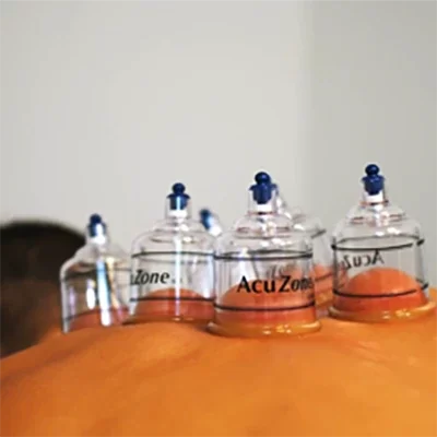 Chiropractic Tempe AZ Treatments Cupping